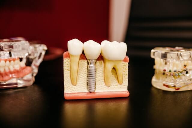 Implant dentar macheta