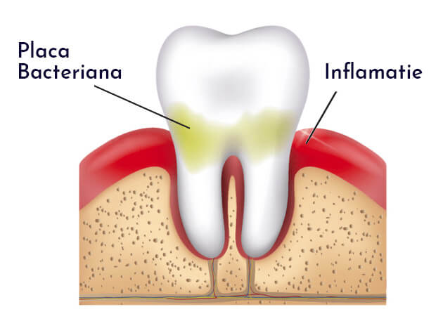 parodontoza - afectiune gingivita