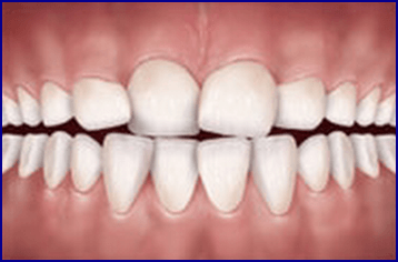 Inghesuire - Aparat dentar - Family Dent