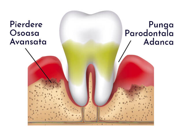parodontoza - afectiune parodontita avansata