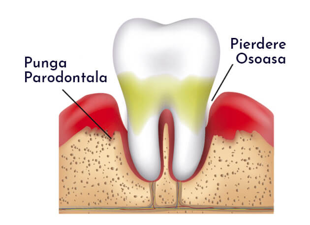 parodontoza - afectiune parodontita