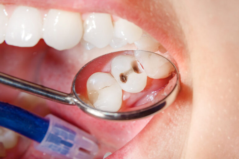 Carii dentare - Tratamente terapeutice dentare