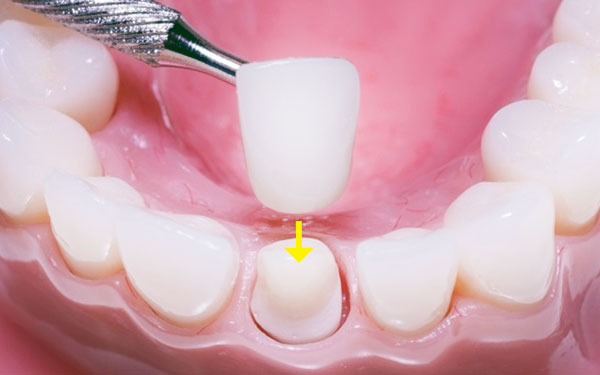 Protetica dentara - Coroane pe zirconiu