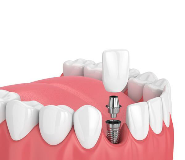 Implant dentar singular, Edentație parțială, cu dinții adiacenți sănătoși