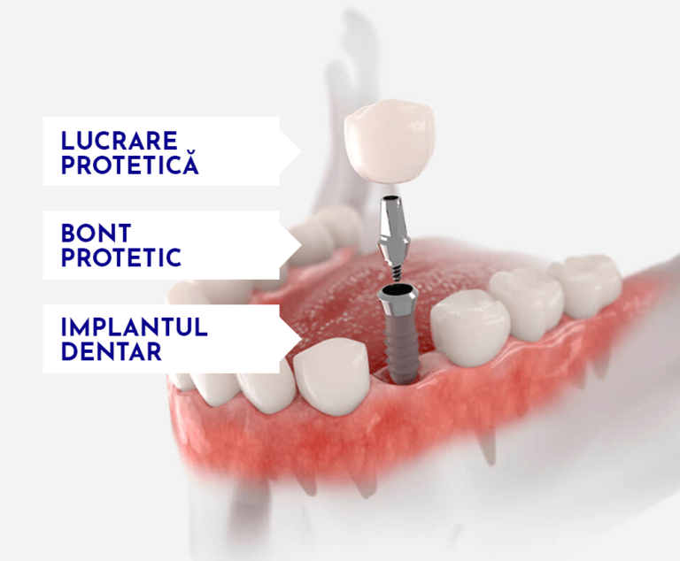 partile componente a unui implant dentar