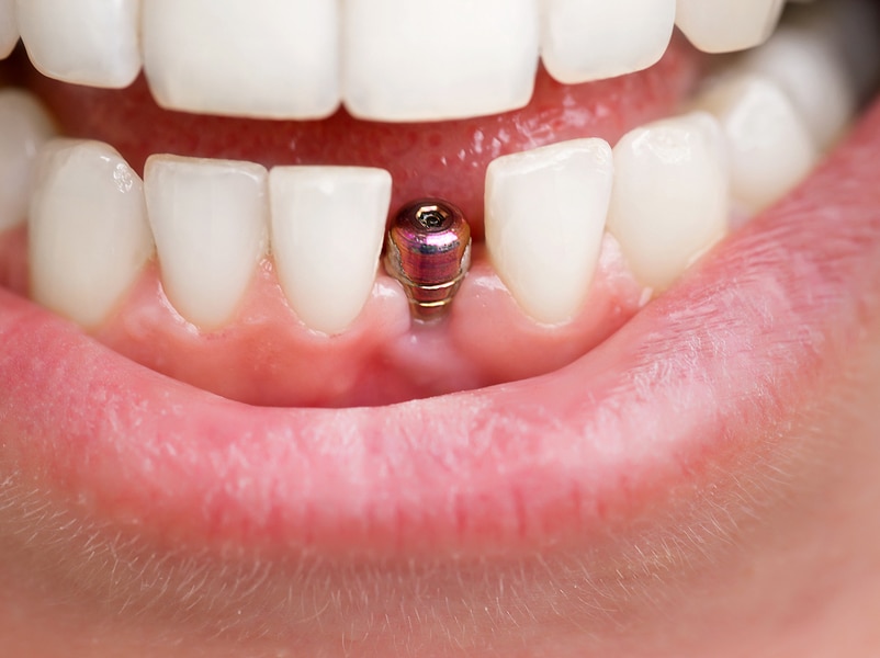 Implant dentar frontal, recuperare-dupa-implant-dentar