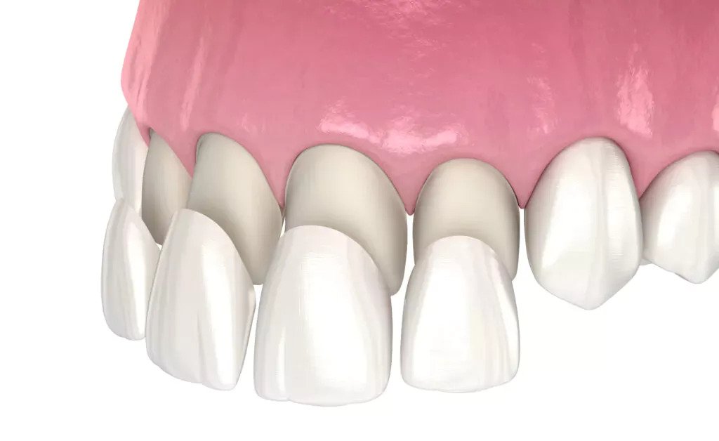 vizualizarea 3d - fatete dentare emax