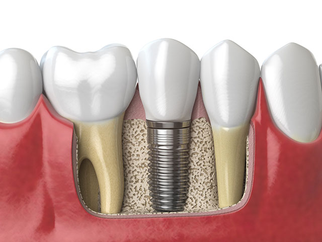 Care sunt potențialele riscuri de respingere a implantului dentar? Află cum să recunoști simptomele și să iei măsuri pentru a asigura succesul intervenției.
